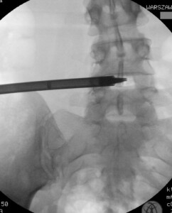 Endoskopowe operacje rys.3