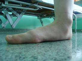 Bok stopy przed operacją